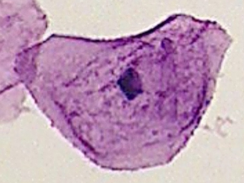 Koilocyt